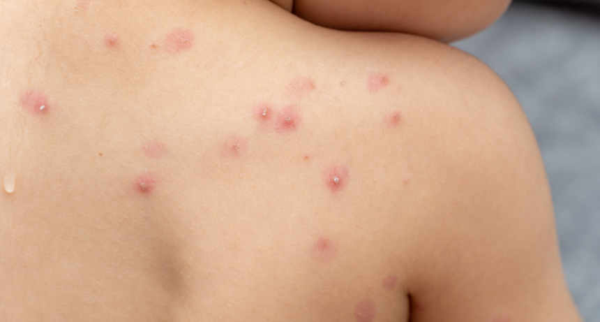  Salud reportó un caso sospechoso de viruela símica en el país 