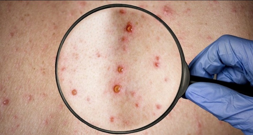 Confirmaron el primer caso argentino de la viruela del mono